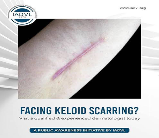 Keloid Scarring Treatment
