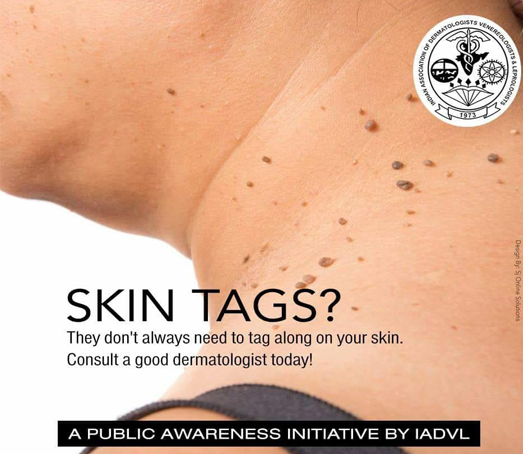 Skin Tags Treatment